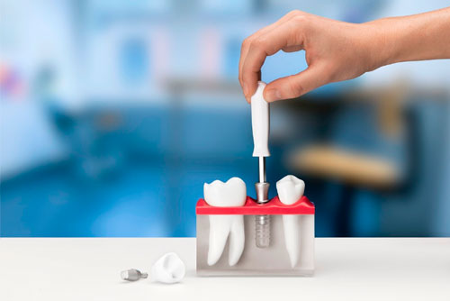 Швейцарские инновации в сфере зубных имплантов