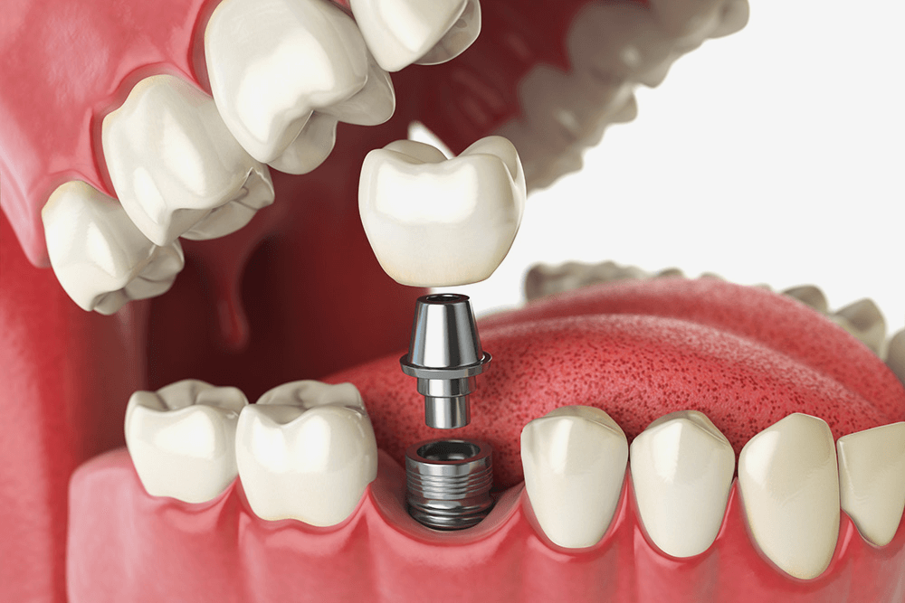 Здоровый уход за зубными имплантами по запатентованной уникальной технологии